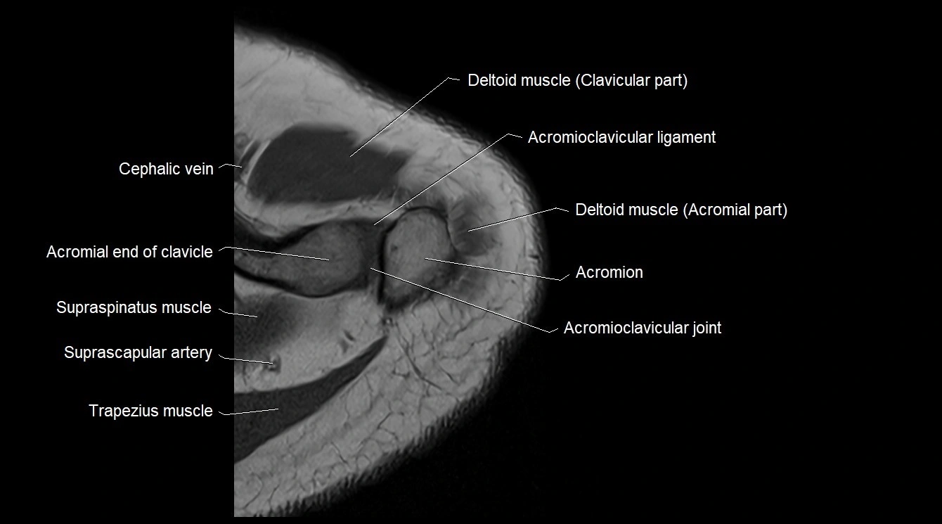 Upper arm( humerus) cross section anatomy MRI 3T axial image 5.webp